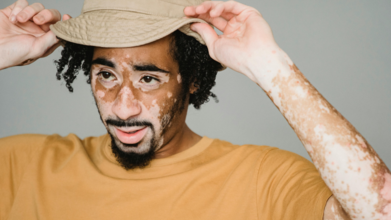Casting homme avec vitiligo entre 25 et 35 ans pour publicité avec marque de prêt à porter